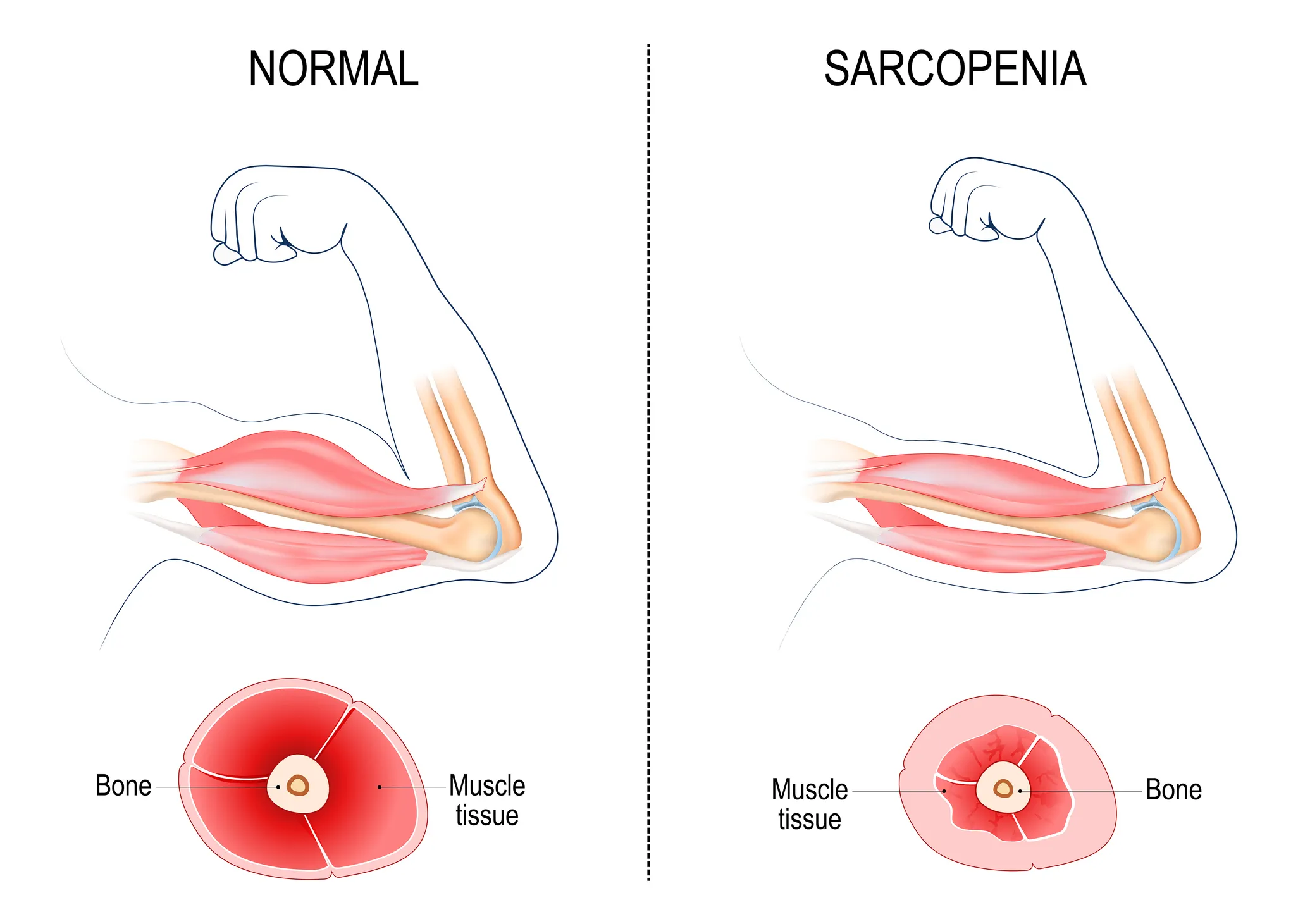 corpo sarcopenia
